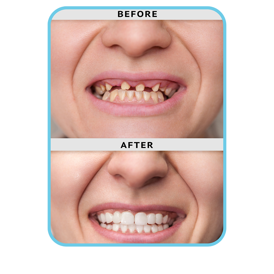 Dental Implants medical planet
